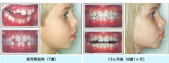 きれいなあごの成長をうながします