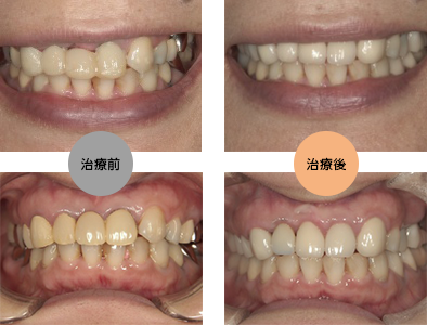 審美歯科 | ウエダ歯科
