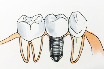 インプラントという選択